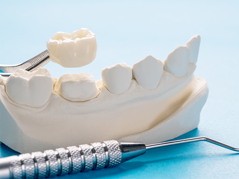 orthosquare crown and Bridges