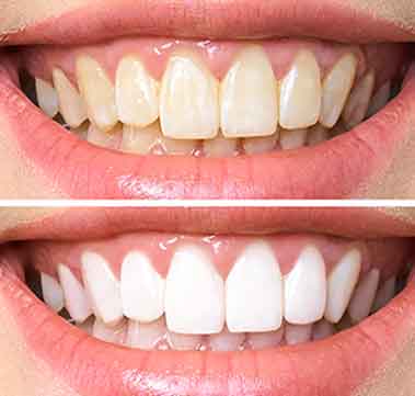 orthosquare teeth whitening