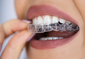 orthosquare teeth braces