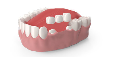 orthosquare crown and Bridges