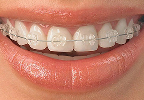 orthosquare teeth braces