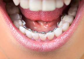 orthosquare teeth braces