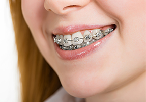 orthosquare teeth braces