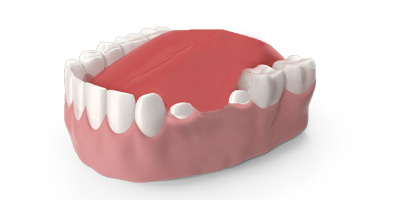 orthosquare crown and Bridges