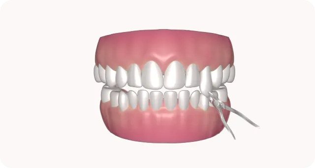 orthosquare tooth extraction