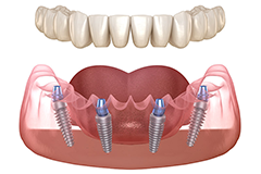 orthosquare invisible aligners