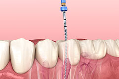 orthosquare root canal