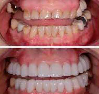 orthosquare root canal