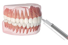 orthosquare root canal